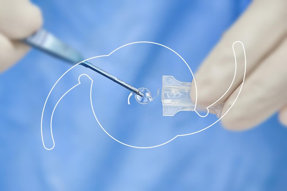 Advancing Eye Care: The Role of Innovative Intraocular Lenses in Modern Surgery